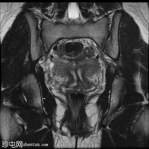 双子宫伴阴道纵隔