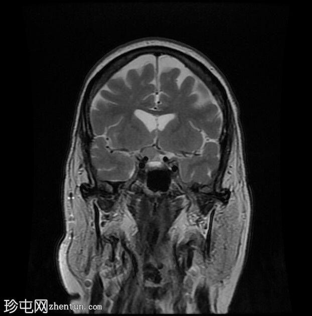 前床突脑膜瘤