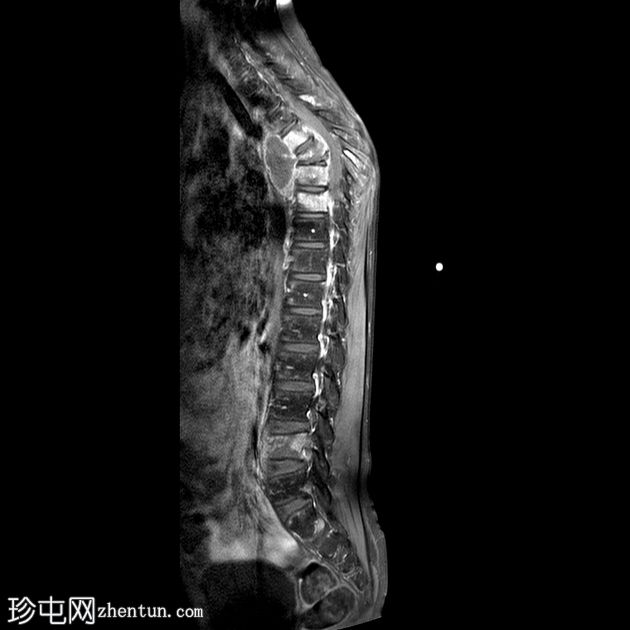 结核性脊椎炎