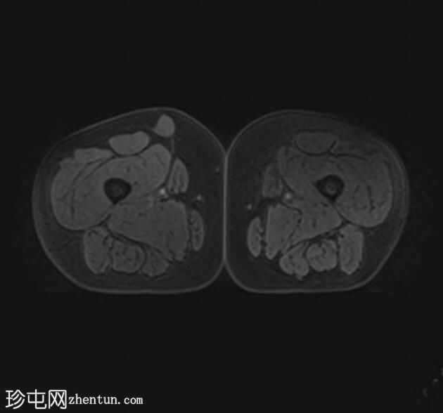 结节性筋膜炎