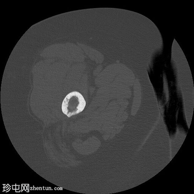 多发性骨髓瘤-右侧股骨近端