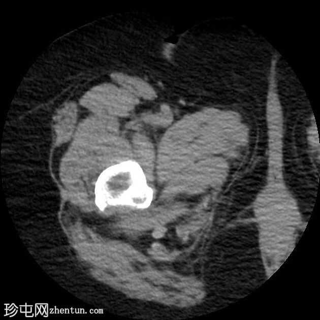 多发性骨髓瘤-右侧股骨近端