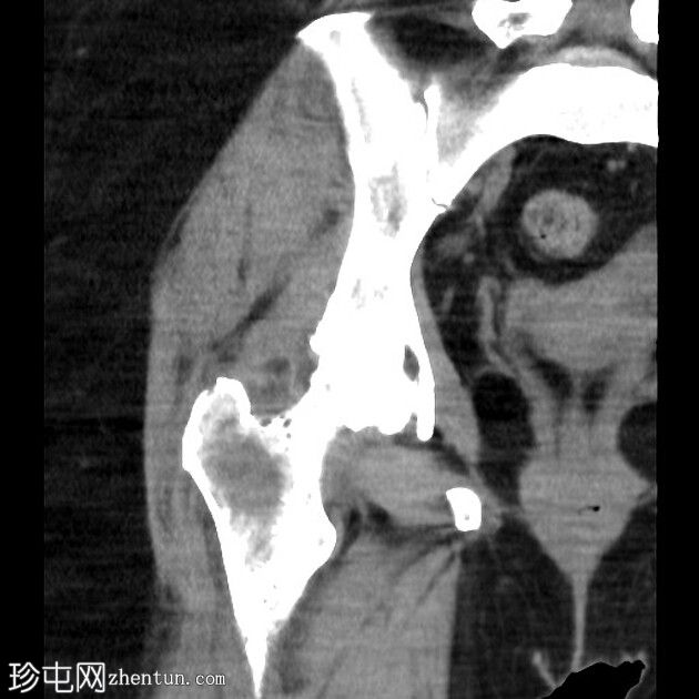 多发性骨髓瘤-右侧股骨近端