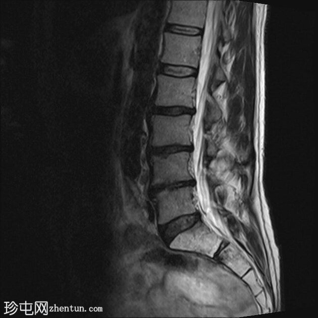 骶骨不全骨折