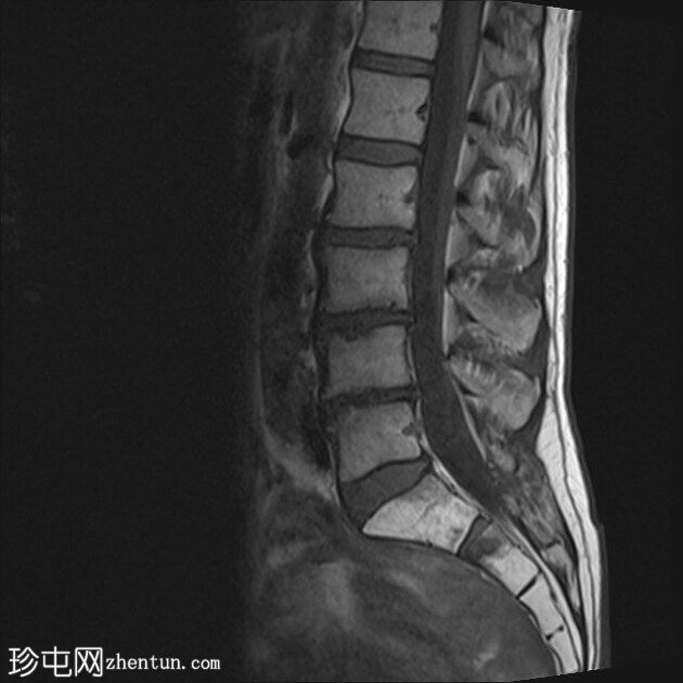 骶骨不全骨折