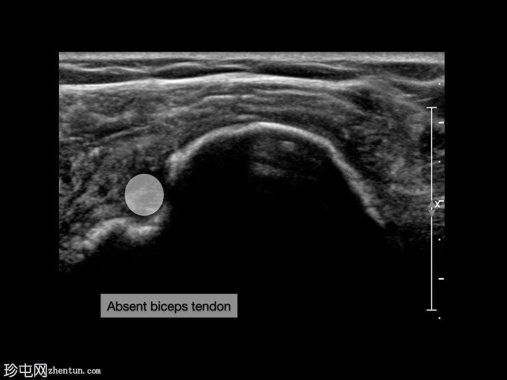 完全冈上冈下肌腱撕裂脱位近端二头肌腱长头(超声)
