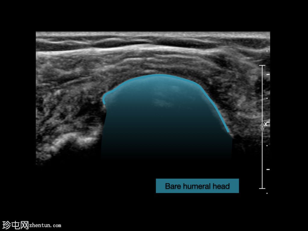 完全冈上冈下肌腱撕裂脱位近端二头肌腱长头(超声)
