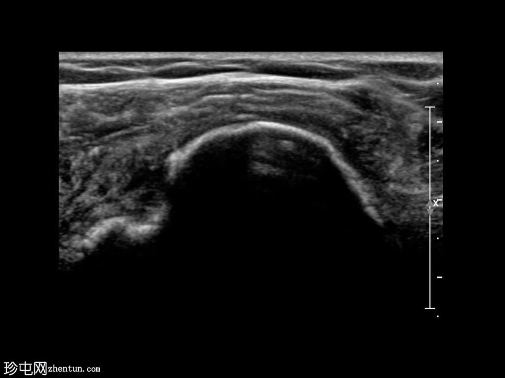完全冈上冈下肌腱撕裂脱位近端二头肌腱长头(超声)
