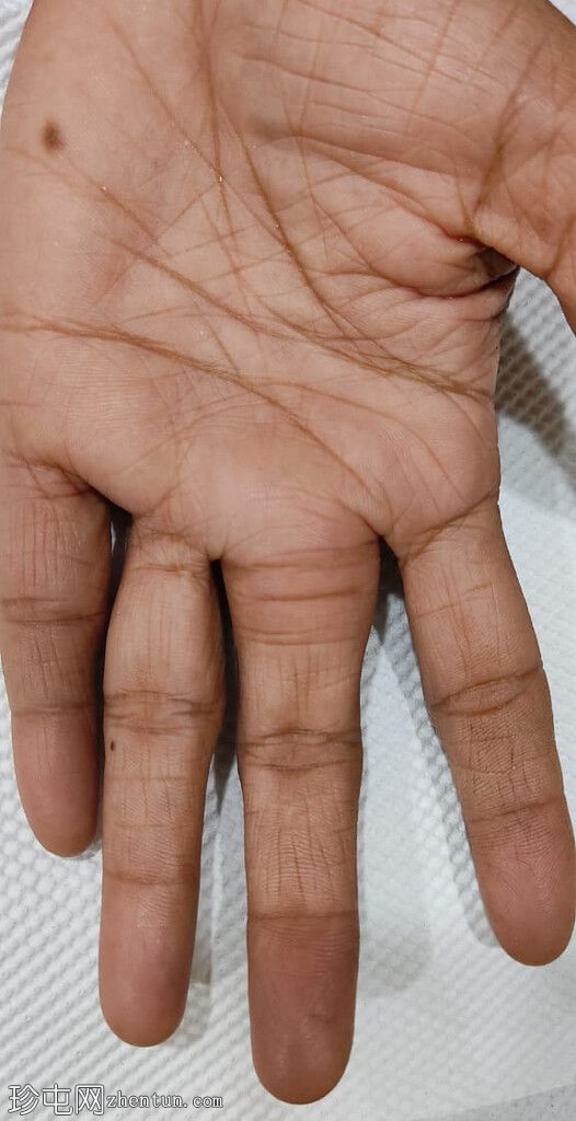 脂肪瘤——手指