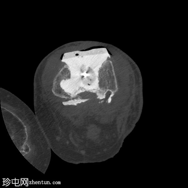 受感染的膝关节垫片