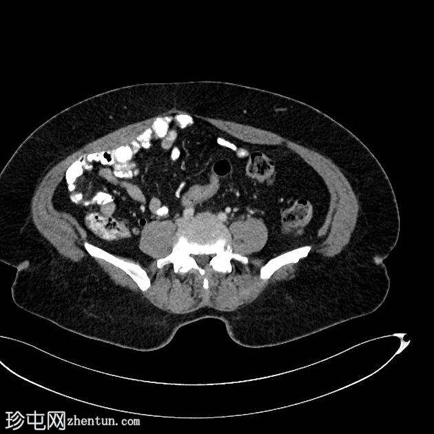 Stercoral结肠炎