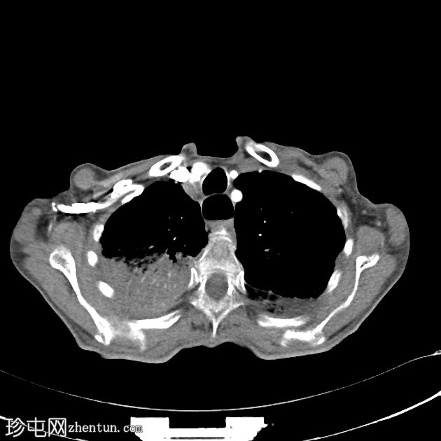 Ivor Lewis食管切除术并发症