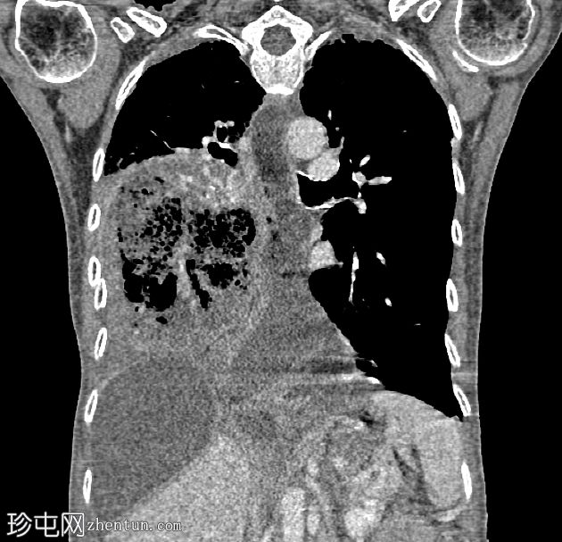 Ivor Lewis食管切除术并发症