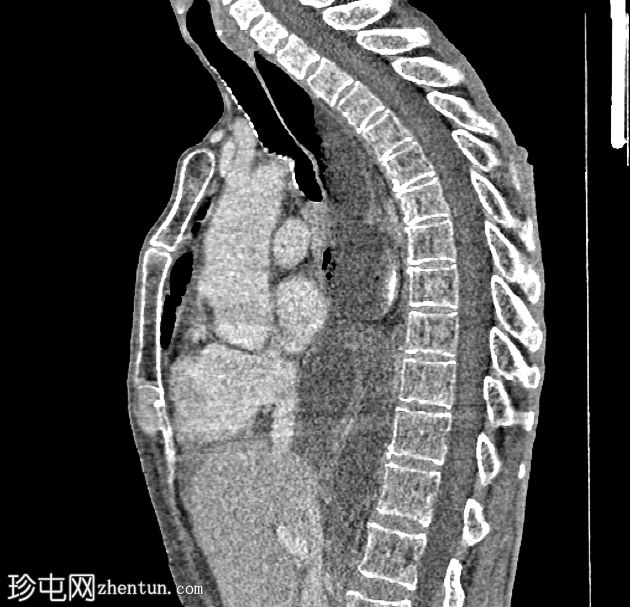 Ivor Lewis食管切除术并发症