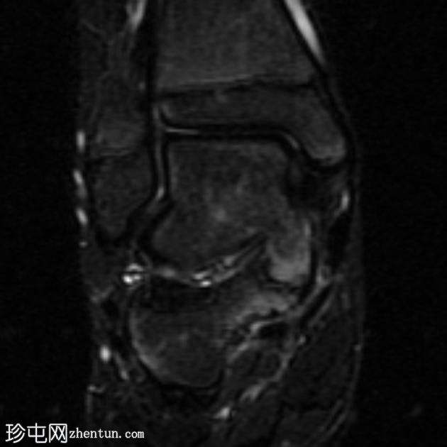 跗骨窦腱鞘囊肿