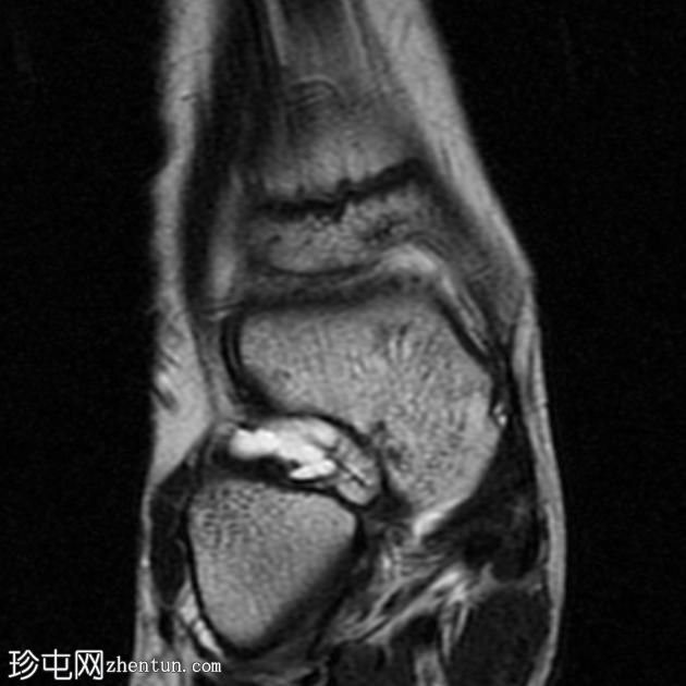 跗骨窦腱鞘囊肿