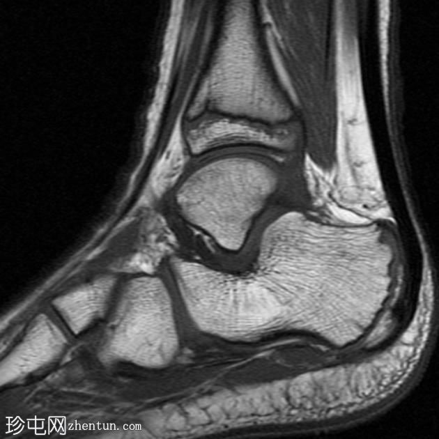 跗骨窦腱鞘囊肿