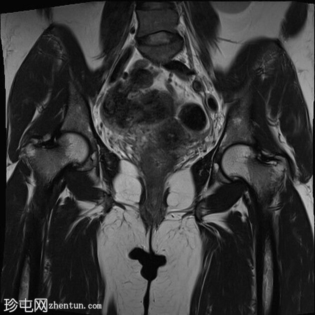 臀小肌腱部分撕裂