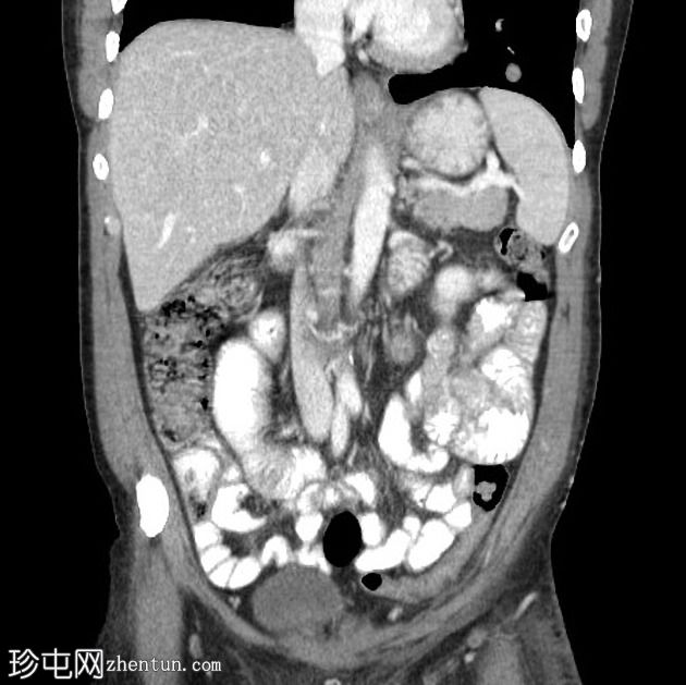 肉瘤转移引起小肠肠套叠