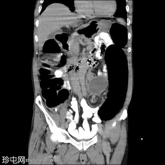 乙状结肠肠扭结