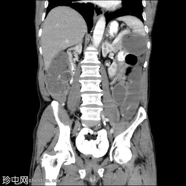 乙状结肠肠扭结