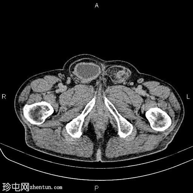 腹股沟疝含膀胱