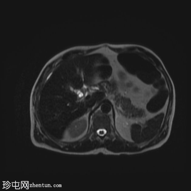 医源性胆管损伤伴胆漏