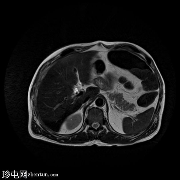 医源性胆管损伤伴胆漏