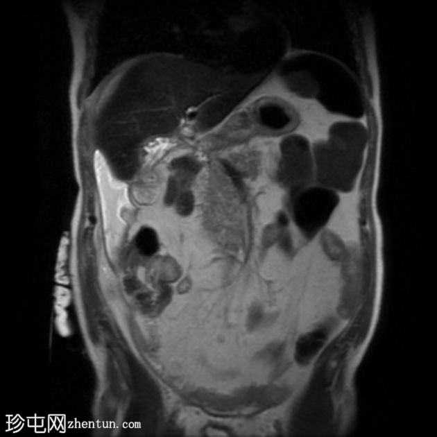 医源性胆管损伤伴胆漏