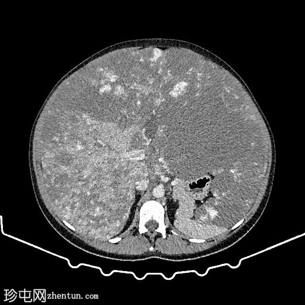 弥漫性肝血管瘤病