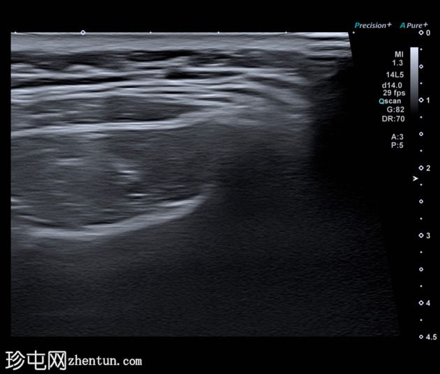 正常肩部超声检查