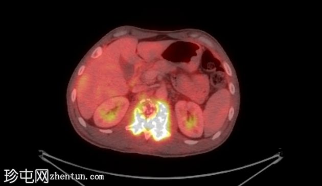 孤立性骨浆细胞瘤(PET-CT)