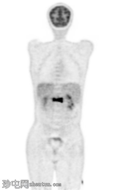 孤立性骨浆细胞瘤(PET-CT)