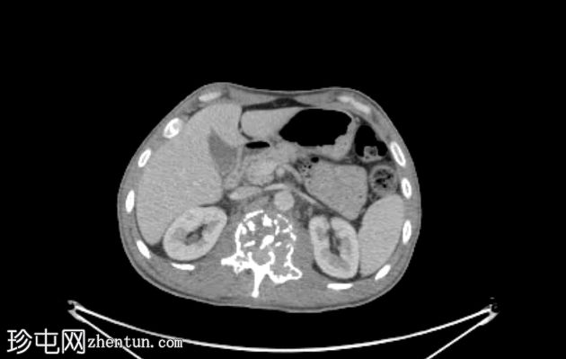 孤立性骨浆细胞瘤(PET-CT)