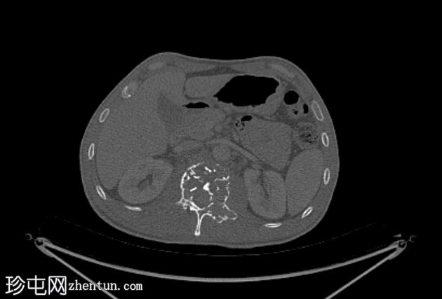 孤立性骨浆细胞瘤(PET-CT)