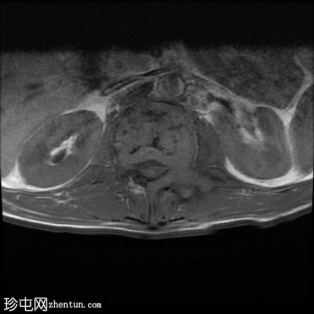 孤立性骨浆细胞瘤(PET-CT)