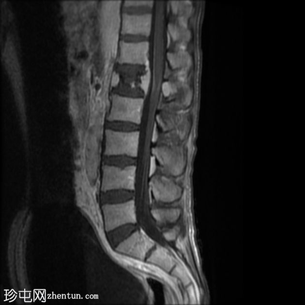 孤立性骨浆细胞瘤(PET-CT)