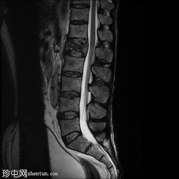 孤立性骨浆细胞瘤(PET-CT)