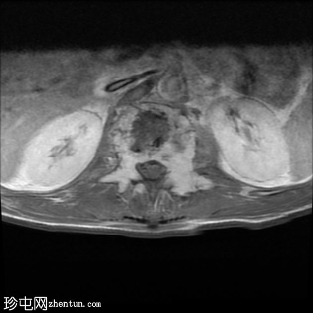 孤立性骨浆细胞瘤(PET-CT)
