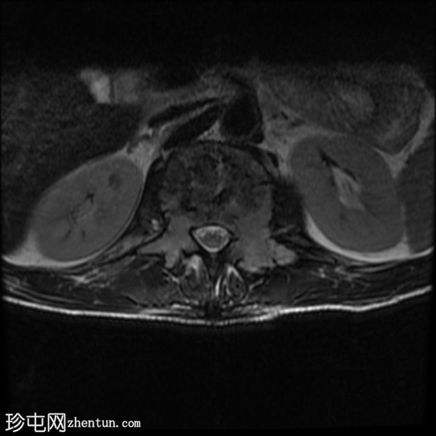 孤立性骨浆细胞瘤(PET-CT)