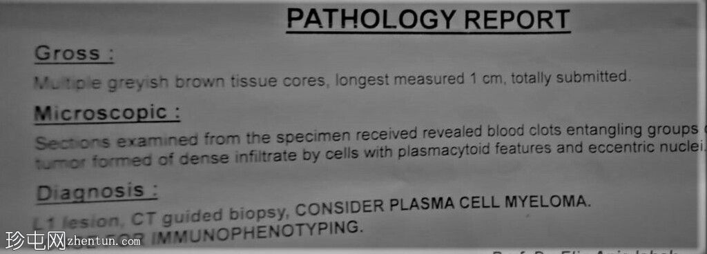 孤立性骨浆细胞瘤(PET-CT)