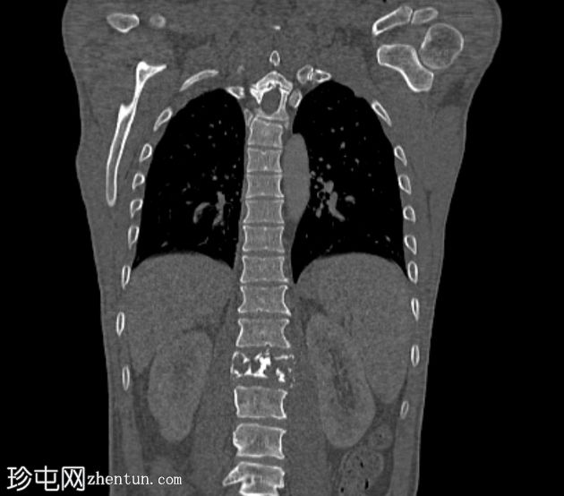 孤立性骨浆细胞瘤(PET-CT)