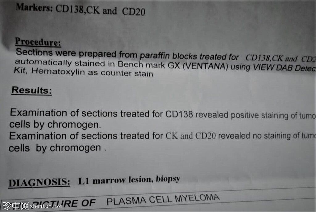 孤立性骨浆细胞瘤(PET-CT)