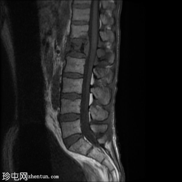 孤立性骨浆细胞瘤(PET-CT)