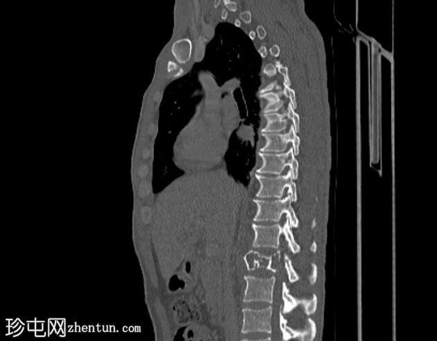 孤立性骨浆细胞瘤(PET-CT)