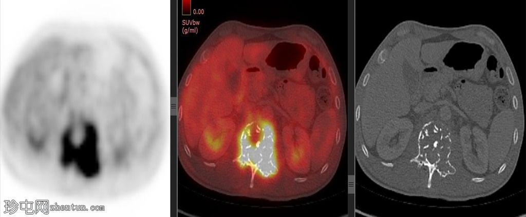 孤立性骨浆细胞瘤(PET-CT)