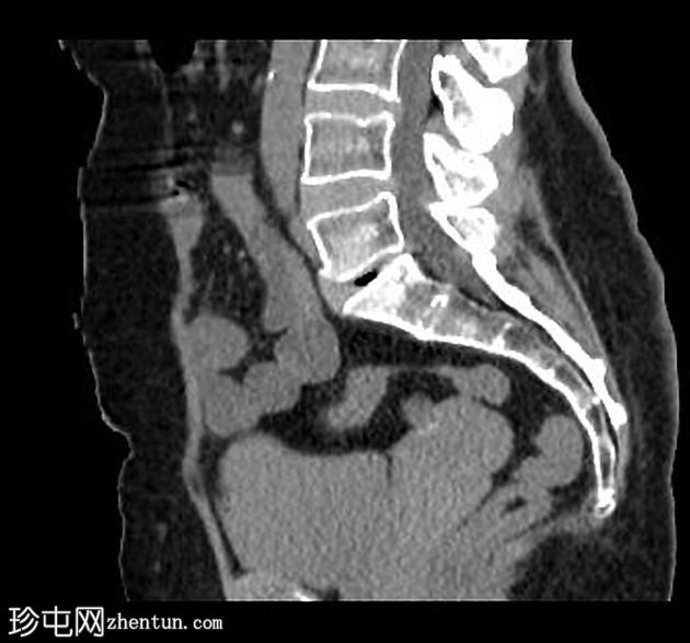 阑尾粘液囊肿