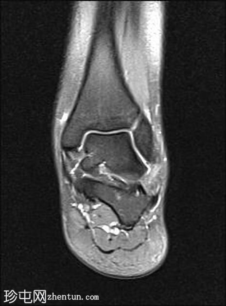 前距腓韧带撕裂