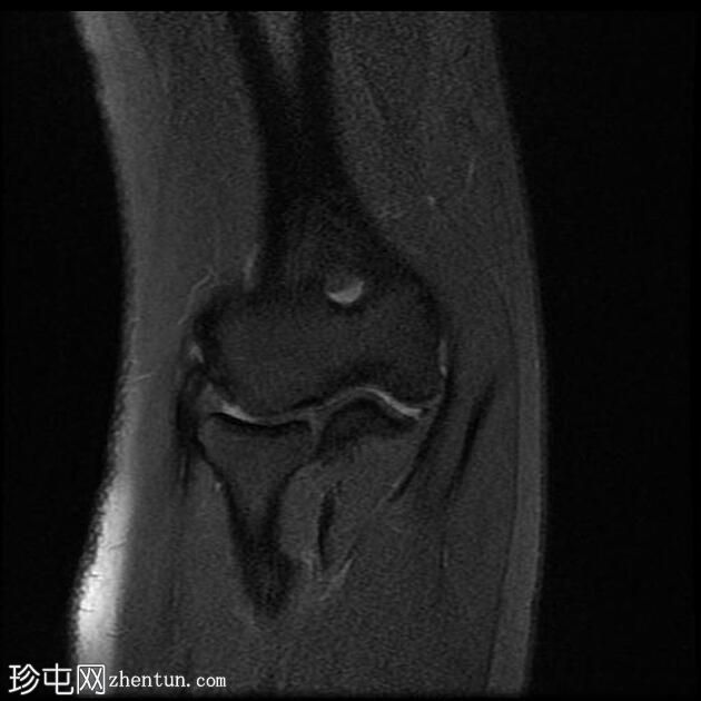 外上髁炎-网球肘