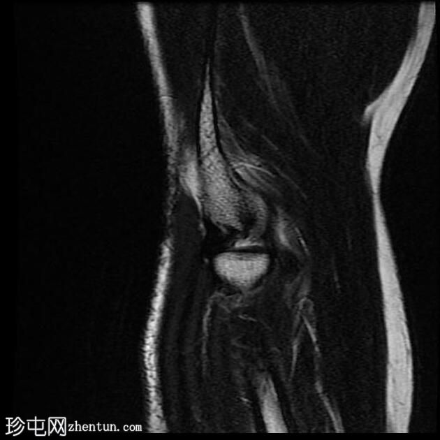 外上髁炎-网球肘